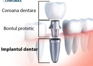 Implant Dentar Galati Chiromax